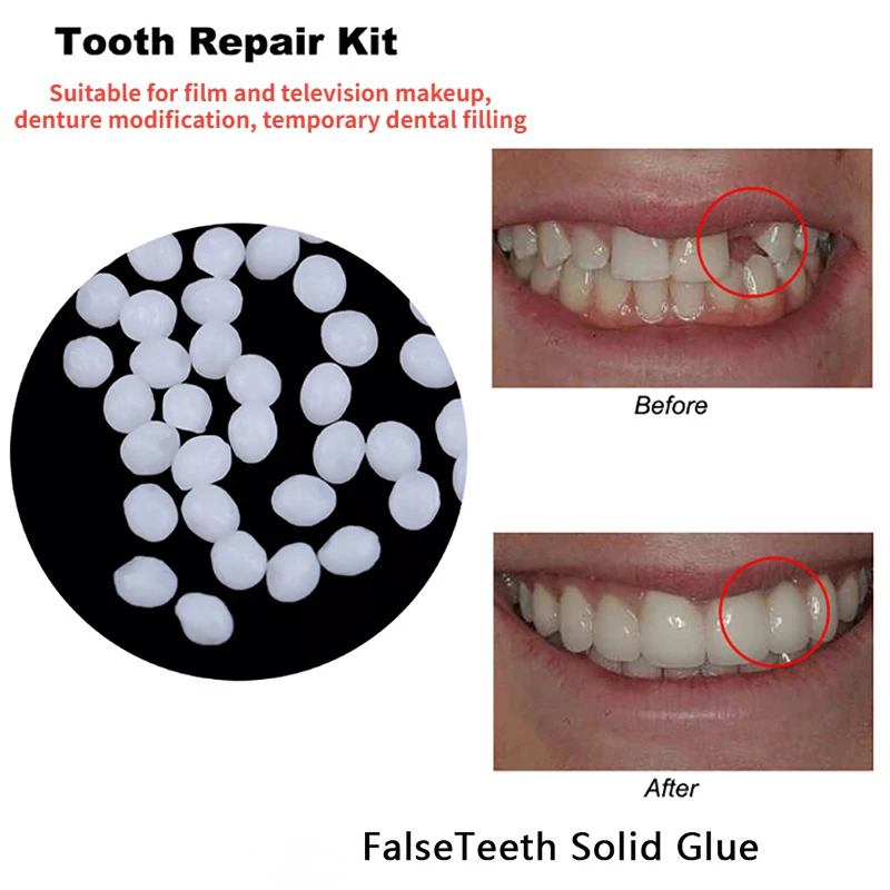 Teeth Whitening At Home - Tooth Repair Glue Shapeable Temporary Gaps