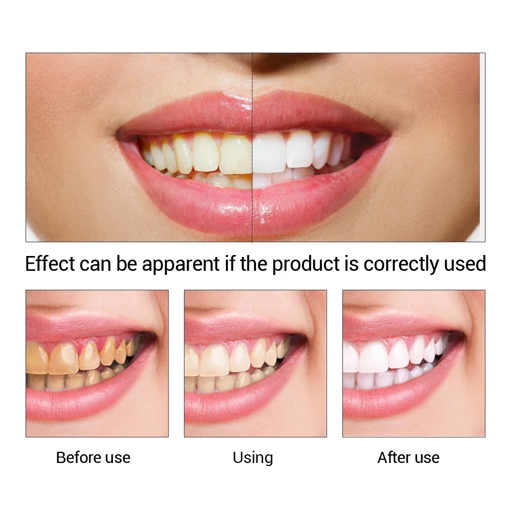 FTEENPLY Teeth Whitening Essen - Teeth Whitening At Home review and price