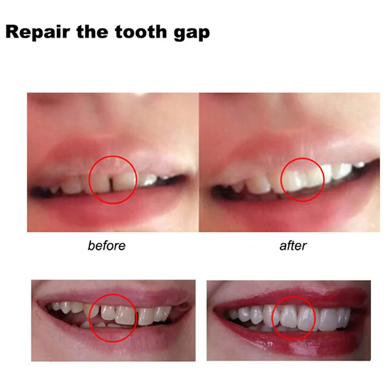 Tooth Repair Glue Shapeable Te - Teeth Whitening At Home review and price