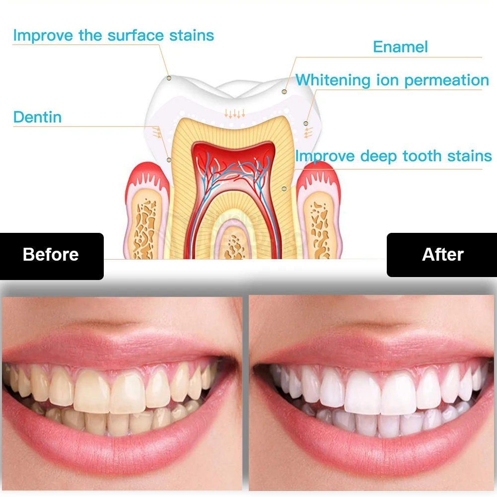 Dental Teeth Whitening Kit Min - Teeth Whitening At Home review and price